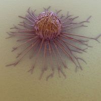 Il terribile Killer...la cellula di cancro al seno al micropscopio...combattetela con la prevenzione