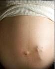 Si fa sterilizzare dopo il quinto figlio, ma resta incinta. Donna chiede il risarcimento danni all'ospedale